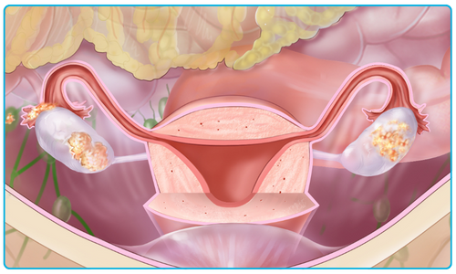 female ovaries showing ovarian cancer