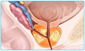showing a human prostate with prostate cancer