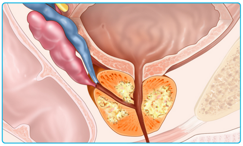 showing a human prostate with prostate cancer